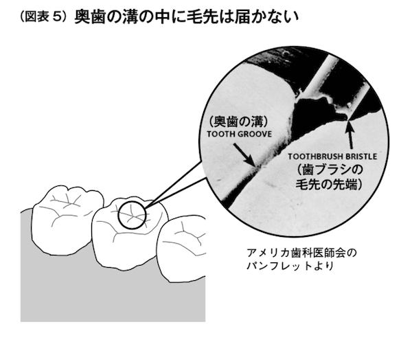 驚きの事実 歯磨きに虫歯予防の効果なし 虫歯を減らす2つの方法とは ニューズウィーク日本版 オフィシャルサイト