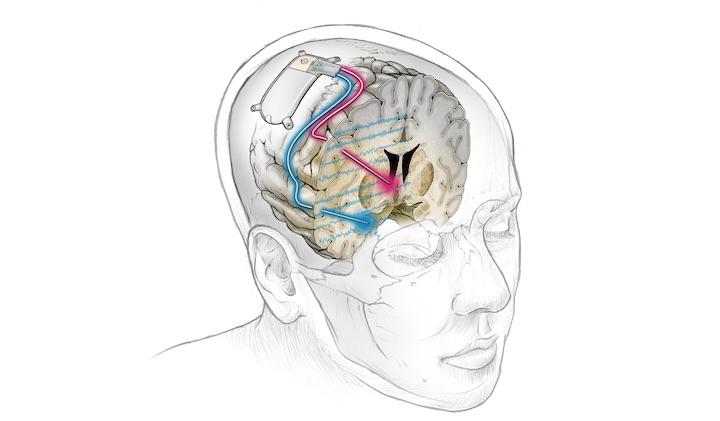 うつ病に治療のための 新たな脳深部刺激療法が開発される ニューズウィーク日本版 オフィシャルサイト
